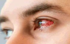Outbreak of eye disease raises concerns in Colombo