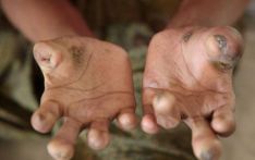 Sri Lanka reports over 1,500 leprosy cases including children