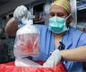 Surgeons perform first combined heart pump and pig kidney transplant