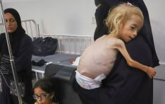 Gaza kids suffer from extreme malnutrition